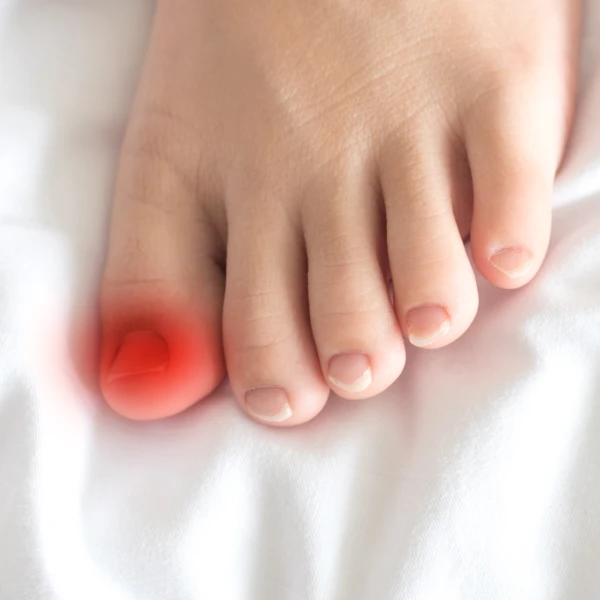 איך לבצע טיפול בפטרת ציפורניים?