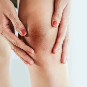 כיצד להבהיר ברכיים כהות?