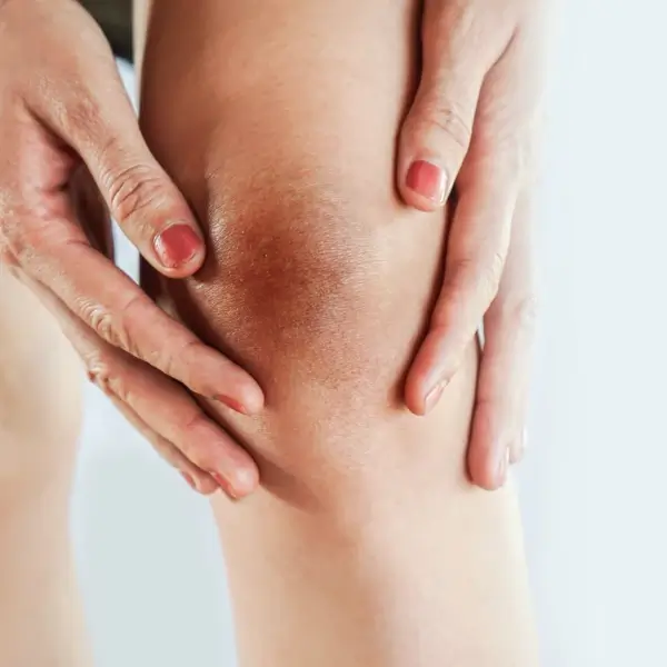 כיצד להבהיר ברכיים כהות?