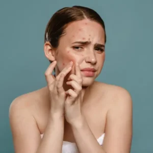 כיצד להשתמש בצללית ירוקה כדי לכסות פצעון אדום?