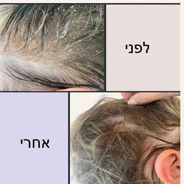 שמפו נגד קשקשים ללא מלחים