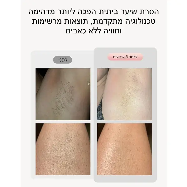 מכשיר להסרת שיער בלייזר ביתי